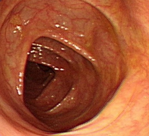 My Colon